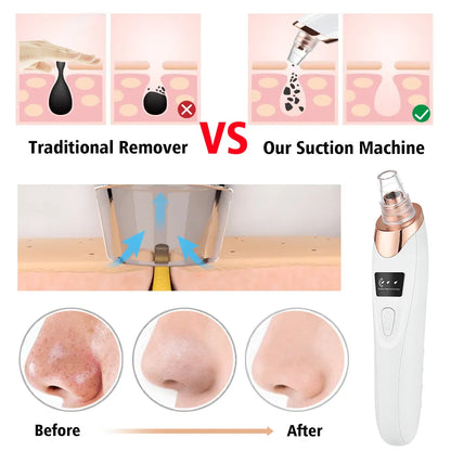 Blackhead Acne Pore Remover